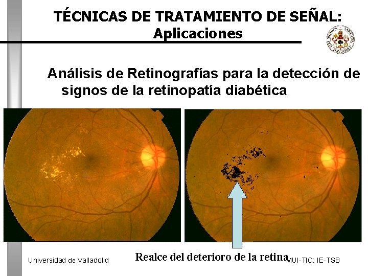 TÉCNICAS DE TRATAMIENTO DE SEÑAL: Aplicaciones Análisis de Retinografías para la detección de signos