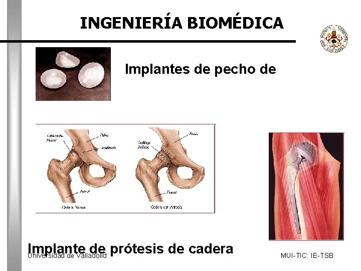 INGENIERÍA BIOMÉDICA silicona, Implantes de pecho de Implante de prótesis de cadera Universidad de