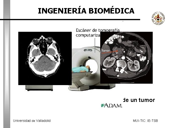 INGENIERÍA BIOMÉDICA Sección del cerebro Detección de un tumor Universidad de Valladolid MUI-TIC: IE-TSB