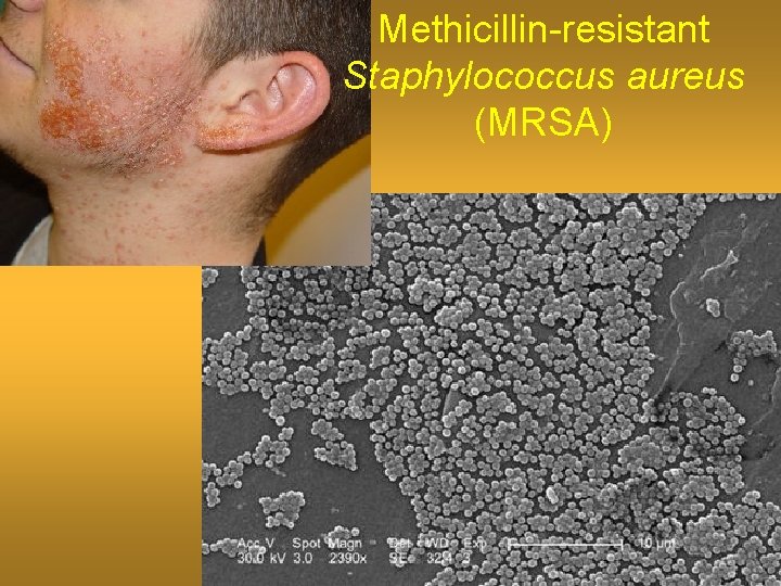 Methicillin-resistant Staphylococcus aureus (MRSA) 