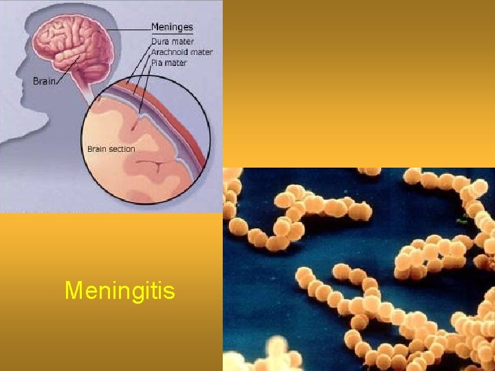 Meningitis 