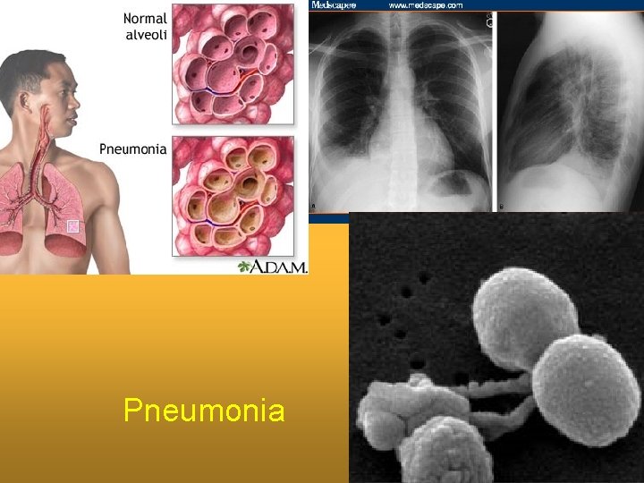 Pneumonia 