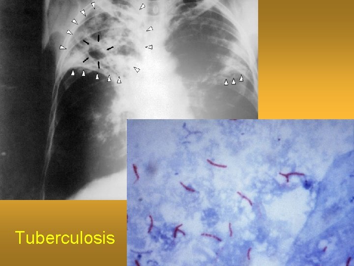 Tuberculosis 