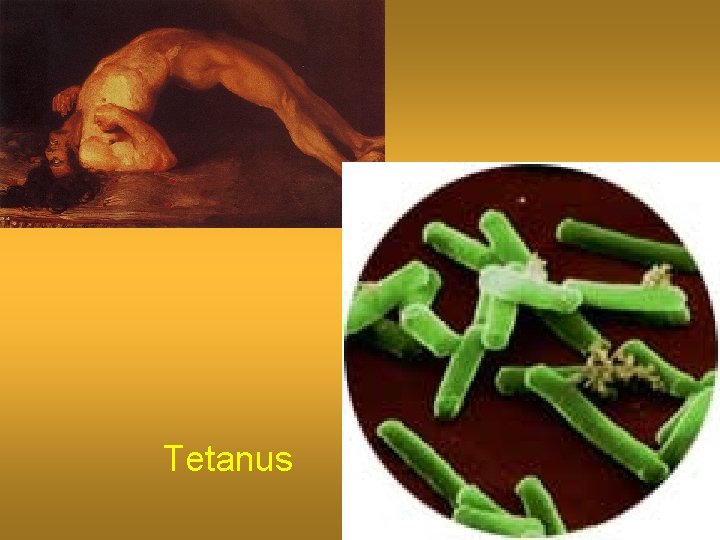 Tetanus 