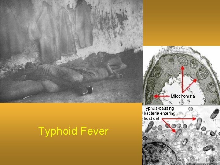 Typhoid Fever 