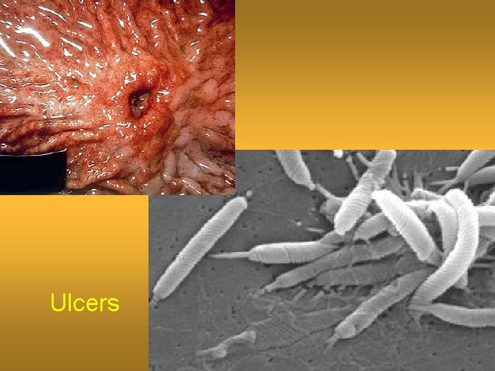 Ulcers 