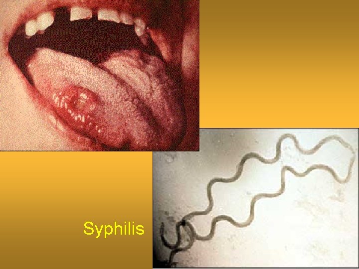 Syphilis 