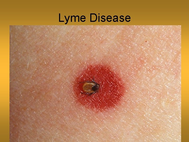 Lyme Disease 