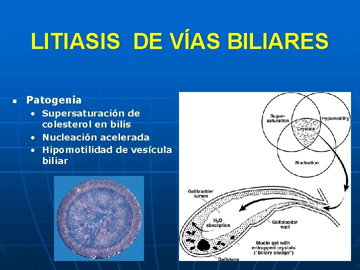 LITIASIS DE VÍAS BILIARES n Patogenia • Supersaturación de colesterol en bilis • Nucleación