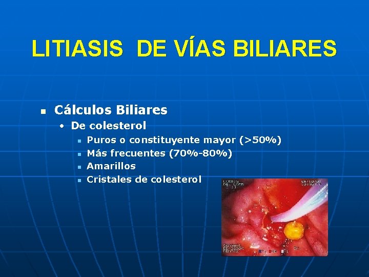 LITIASIS DE VÍAS BILIARES n Cálculos Biliares • De colesterol n n Puros o