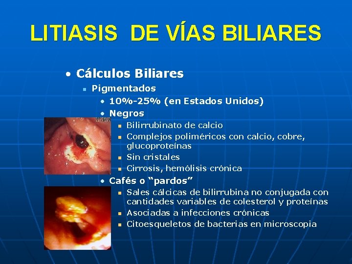 LITIASIS DE VÍAS BILIARES • Cálculos Biliares n Pigmentados • 10%-25% (en Estados Unidos)