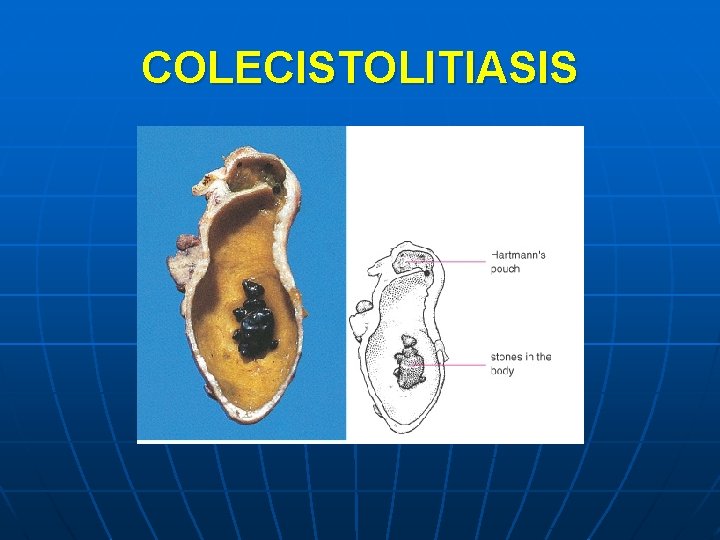 COLECISTOLITIASIS 