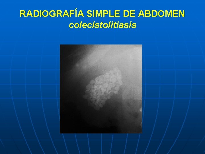 RADIOGRAFÍA SIMPLE DE ABDOMEN colecistolitiasis 