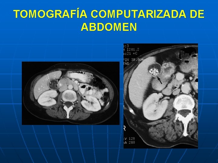 TOMOGRAFÍA COMPUTARIZADA DE ABDOMEN 