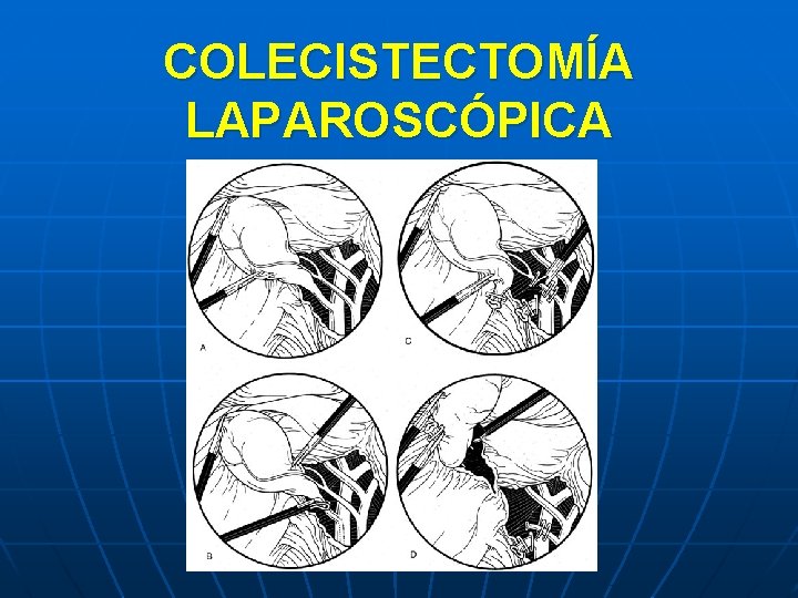 COLECISTECTOMÍA LAPAROSCÓPICA 