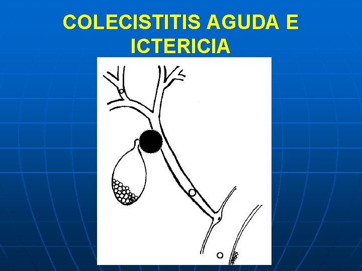 COLECISTITIS AGUDA E ICTERICIA 