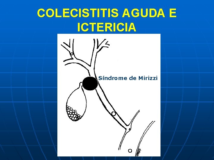 COLECISTITIS AGUDA E ICTERICIA Síndrome de Mirizzi 