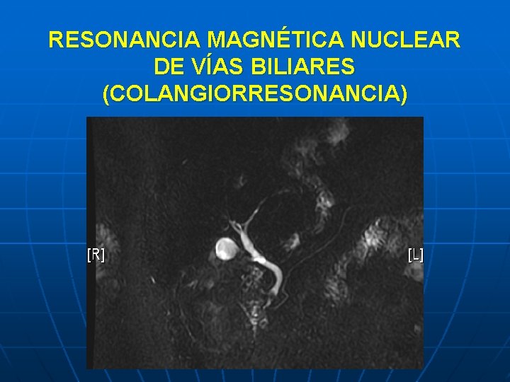 RESONANCIA MAGNÉTICA NUCLEAR DE VÍAS BILIARES (COLANGIORRESONANCIA) 