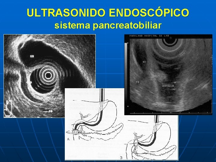 ULTRASONIDO ENDOSCÓPICO sistema pancreatobiliar 