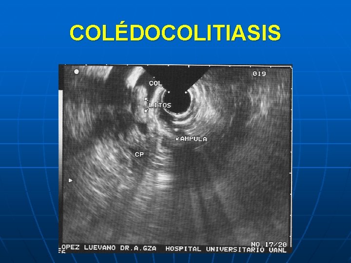 COLÉDOCOLITIASIS 