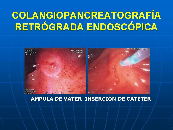 COLANGIOPANCREATOGRAFÍA RETRÓGRADA ENDOSCÓPICA AMPULA DE VATER INSERCION DE CATETER 