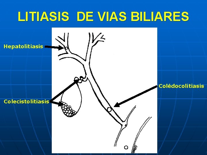 LITIASIS DE VIAS BILIARES Hepatolitiasis Colédocolitiasis Colecistolitiasis 