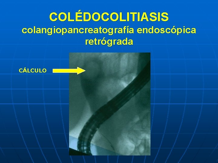 COLÉDOCOLITIASIS colangiopancreatografía endoscópica retrógrada CÁLCULO 