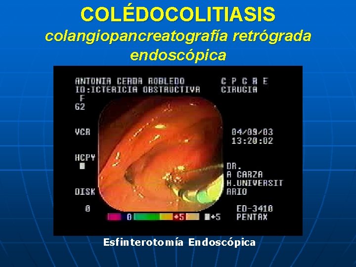 COLÉDOCOLITIASIS colangiopancreatografía retrógrada endoscópica Esfinterotomía Endoscópica 