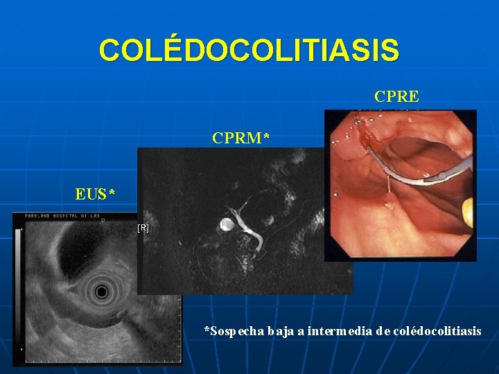 COLÉDOCOLITIASIS CPRE CPRM* EUS* *Sospecha baja a intermedia de colédocolitiasis 