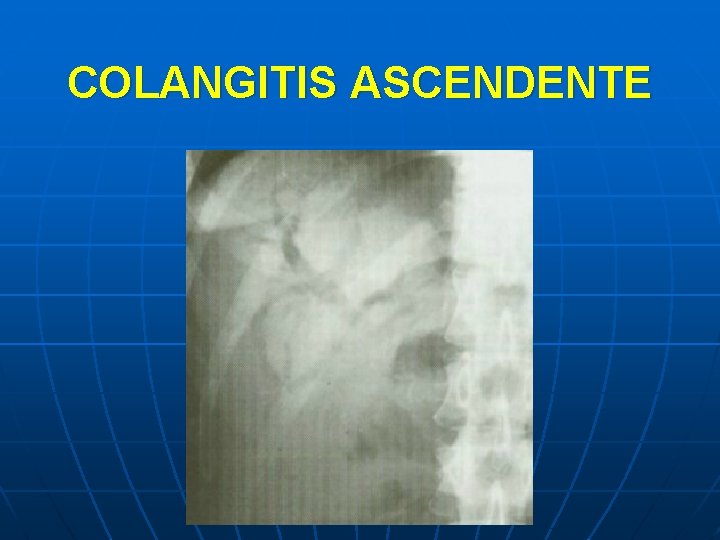 COLANGITIS ASCENDENTE 