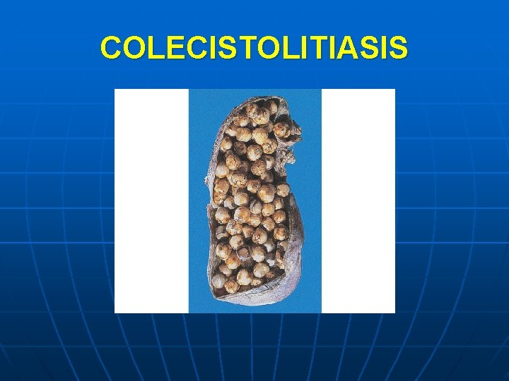 COLECISTOLITIASIS 