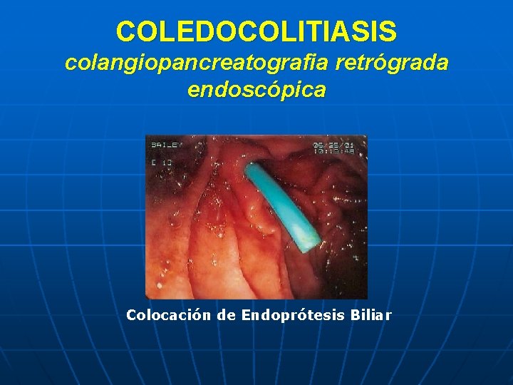 COLEDOCOLITIASIS colangiopancreatografia retrógrada endoscópica Colocación de Endoprótesis Biliar 