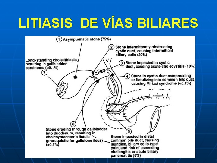 LITIASIS DE VÍAS BILIARES 