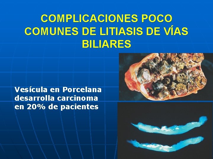 COMPLICACIONES POCO COMUNES DE LITIASIS DE VÍAS BILIARES Vesícula en Porcelana desarrolla carcinoma en