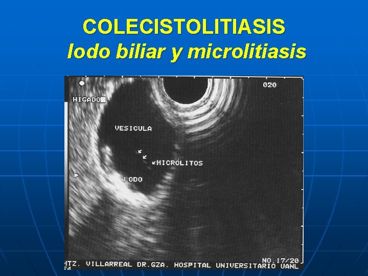 COLECISTOLITIASIS lodo biliar y microlitiasis 