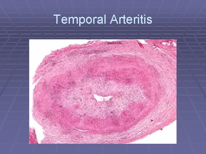 Temporal Arteritis 