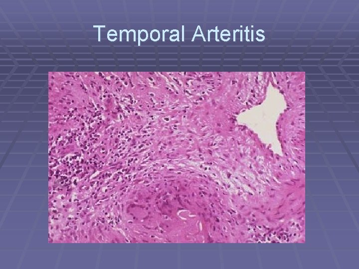 Temporal Arteritis 