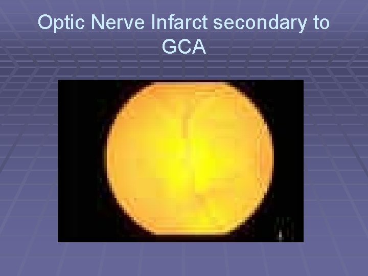 Optic Nerve Infarct secondary to GCA 