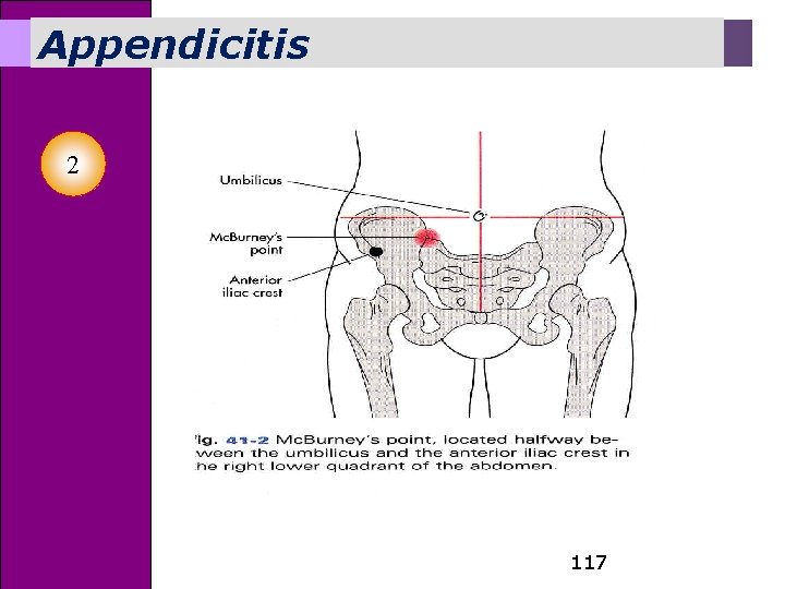 Appendicitis 2 117 