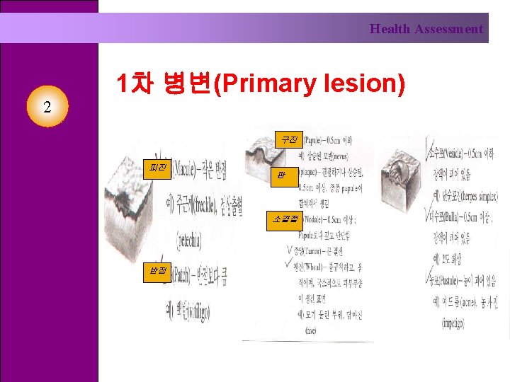 Health Assessment 2 1차 병변(Primary lesion) 구진 피진 판 소결절 반점 