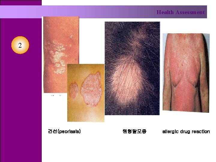 Health Assessment 2 건선(psoriasis) 원형탈모증 allergic drug reaction 