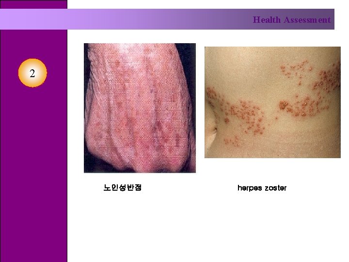 Health Assessment 2 노인성반점 herpes zoster 