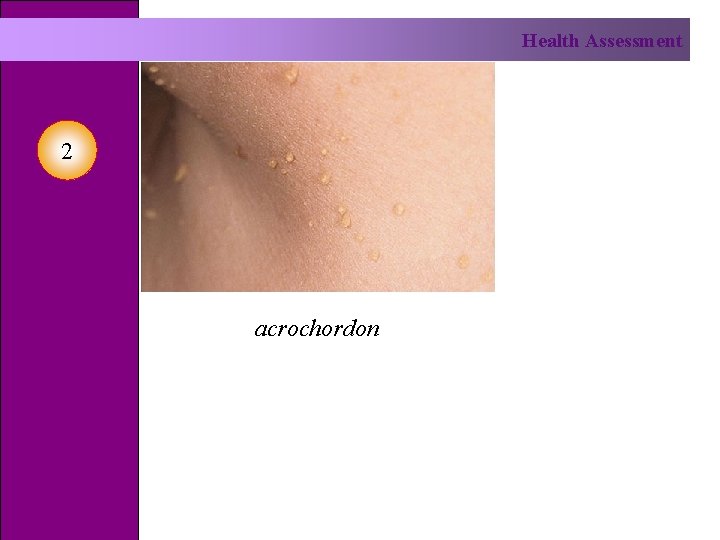 Health Assessment 2 acrochordon 