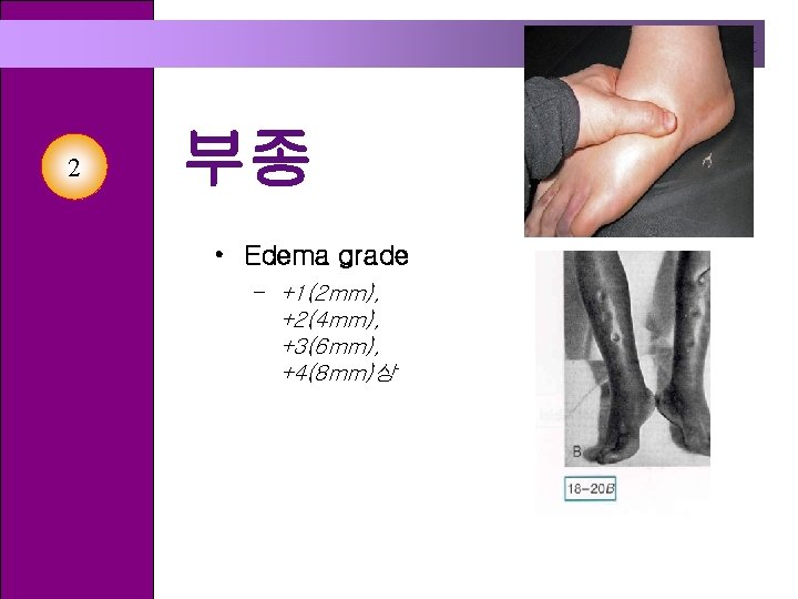 Health Assessment 2 부종 • Edema grade – +1(2 mm), +2(4 mm), +3(6 mm),