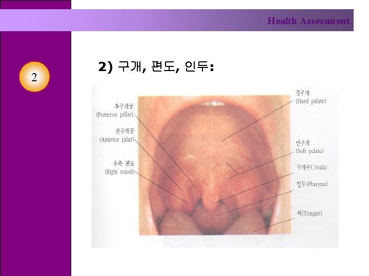 Health Assessment 2 2) 구개, 편도, 인두: 