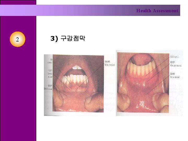 Health Assessment 2 3) 구강점막 