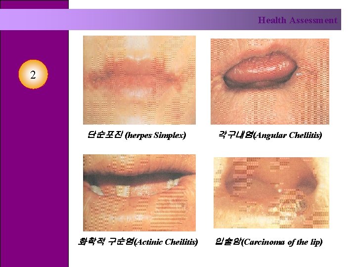 Health Assessment 2 단순포진 (herpes Simplex) 각구내염(Angular Chellitis) 화학적 구순염(Actinic Cheilitis) 입술암(Carcinoma of the