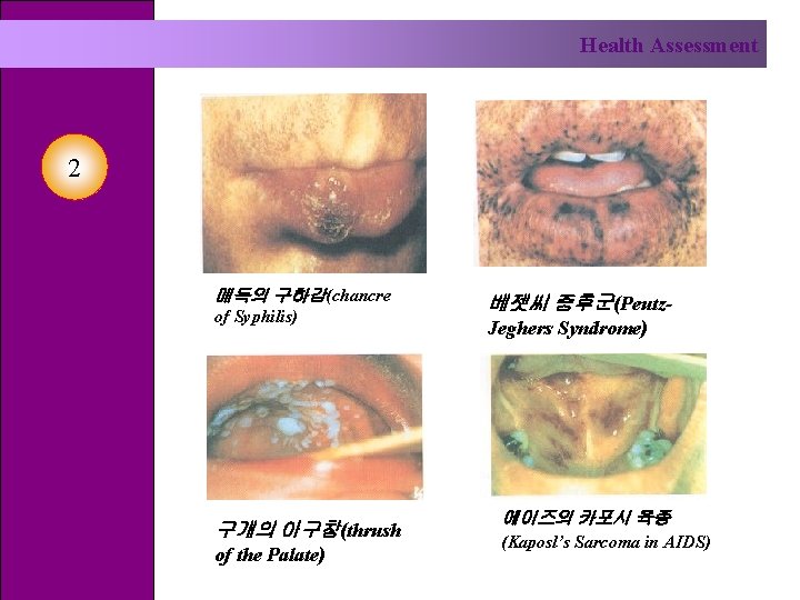 Health Assessment 2 매독의 구하감(chancre of Syphilis) 구개의 아구창(thrush of the Palate) 베젯씨 증후군(Peutz.