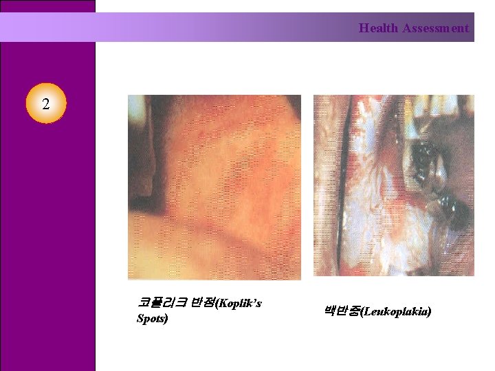 Health Assessment 2 코플리크 반점(Koplik’s Spots) 백반증(Leukoplakia) 