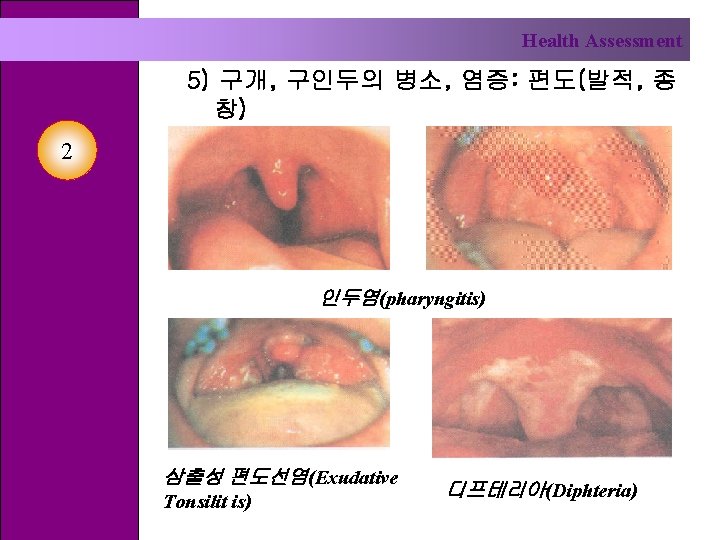 Health Assessment 5) 구개, 구인두의 병소, 염증: 편도(발적, 종 창) 2 인두염(pharyngitis) 삼출성 편도선염(Exudative
